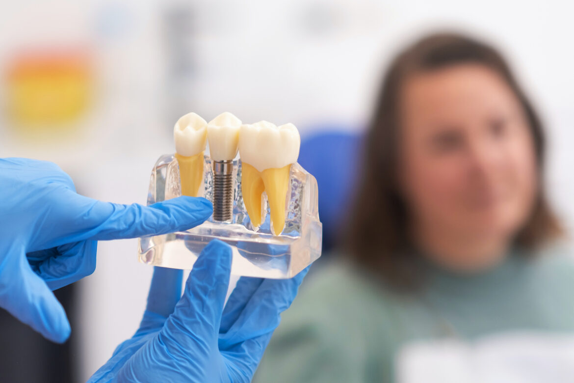 Jak odbudować uśmiech po utracie zębów? Wszystko o implantach